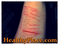 Self harm pictures and why people want to look at self mutilation pictures and self injury photos. Read why self harm images trigger people to inflict self harm.