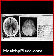 Neurologist John Friedberg how psychiatric drugs and electroshock damage the brain. He says all suffer some brain damage and memory loss.