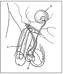 Drawing of an inflatable implant to treat erectile dysfunction. An erection is produced by squeezing a small pump (a) implanted in a scrotum. The pump causes fluid to flow from a reservoir (b) residing in the lower pelvis to two cylinders (c) residing in the penis. The cylinders expand to create the erection.