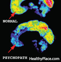 The psychopathic brain has been an area of interest in research to try to determine how psychopaths think but how different is the brain of a psychopath?